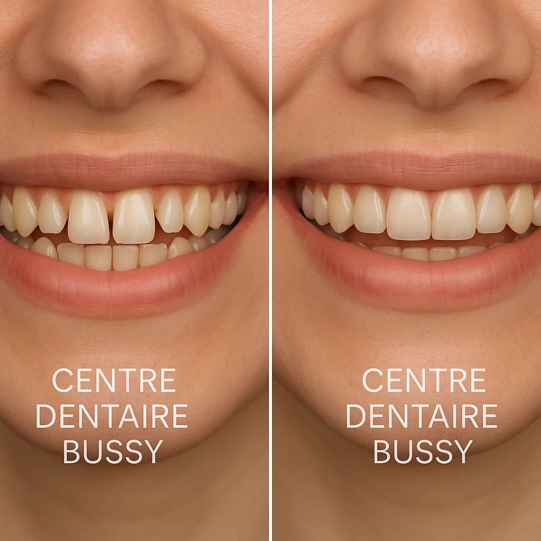 Avant / Après orthodontie cas 4